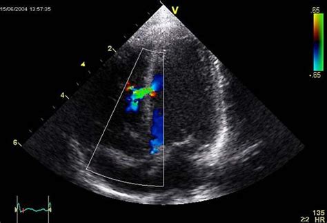 Echocardiography Ultrasound Heart Imaging Diagnosis Britannica