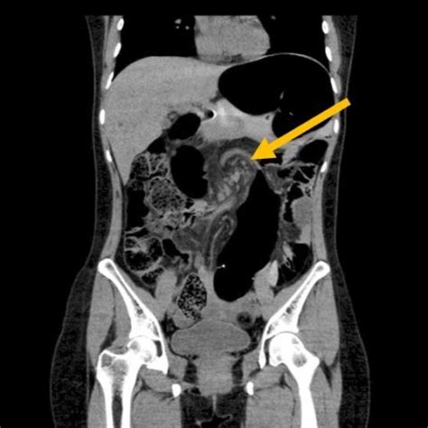 Recurrent Sigmoid Volvulus in a Young Female - JETem