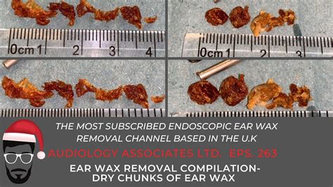 Ear Wax Removal Compilation Dry Chunks Of Ear Wax Ep Youtube