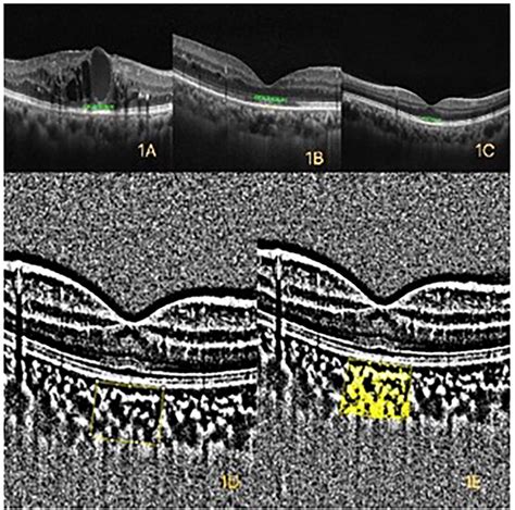 Figure 1 From Quantitative Assessment Of OCT And OCTA Parameters In