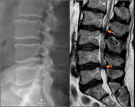 The Radiology Assistant Lumbar Disc Herniation