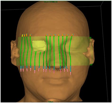 Jpm Free Full Text Personalized Superficial Hdr Brachytherapy