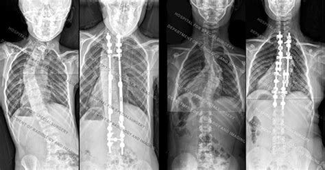 Neurofibromatosis Type 1: Orthopedic Complications | HSS