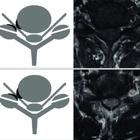 Grading For Cervical Neural Foraminal Stenosis A Grade 1 Non Severe