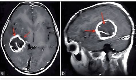 Contrast MRI. Contrast MRI of the brain axial (a) and sagittal images ...