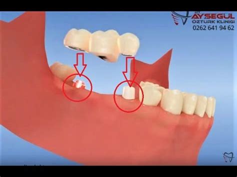 K Pr Restorasyon Yap M Nda Di Implant Ba Lanmas Youtube