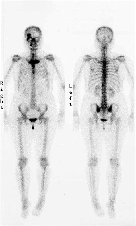 Figure Bone Scintigraphy With Mtc Complexes Mtc Bone