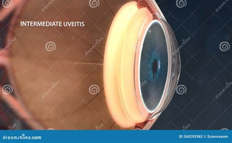 Uveitis Is The Inflammation Of Part Or All Of The Uvea In The Eye It