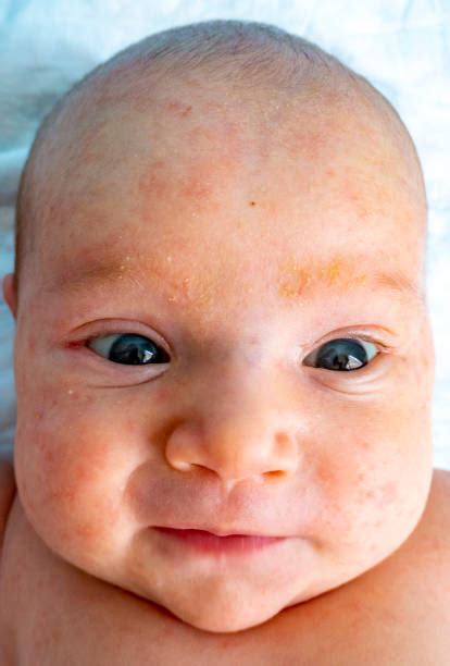 90 Newborn Face Rash Stock Photos Pictures And Royalty Free Images Istock