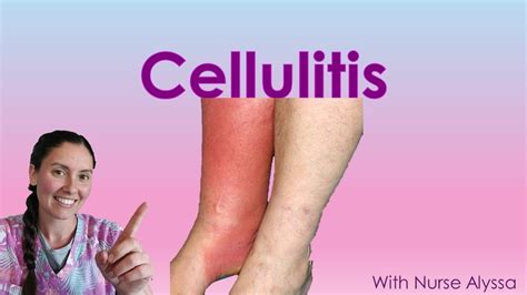 Cellulitis YouTube