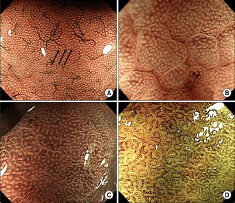 Typical Cases Of 1 Normal And 3 Abnormal Gastric Mucosal Patterns In