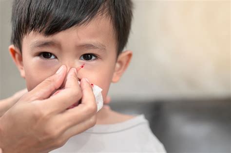 Nasenbluten Bei Kindern Ursachen Und Erste Hilfe Eltern De