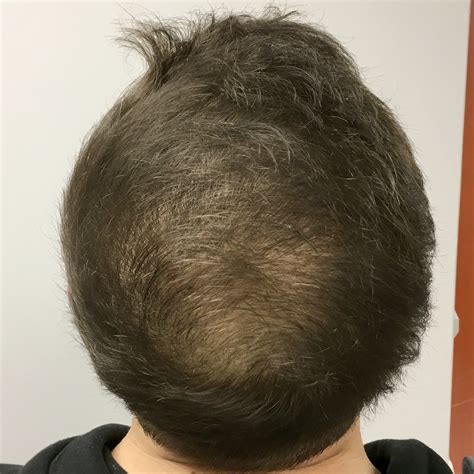 Effective Prf Hair Restoration In Seattle Book Now