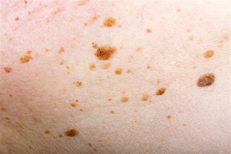 Nevus On The Skin Melanoma Or Cancer Dermatology Stock Image Image