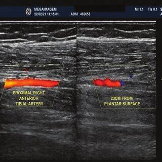 Arterial Doppler Image Showing Occlusion Of The Right Anterior Tibial