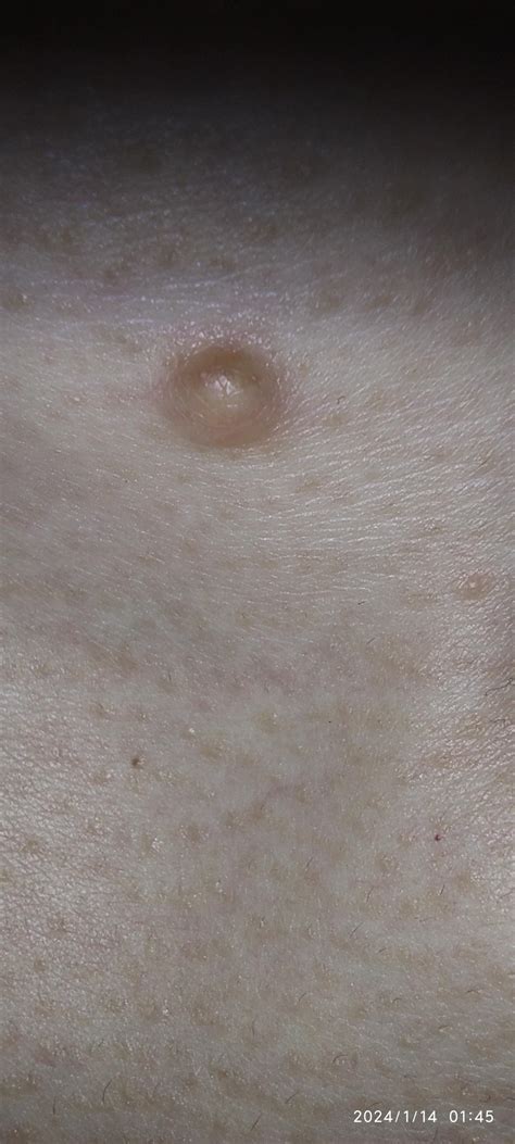 I have this lump on my neck : r/DiagnoseMe