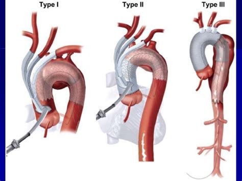 Aortic Dissection Repair Surgery