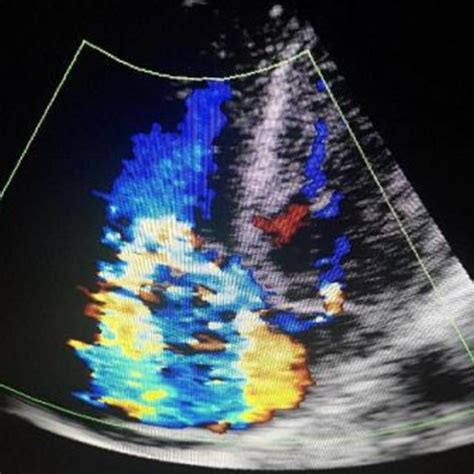 Transthoracic Echocardiography Showing Severe Tricuspid Regurgitation