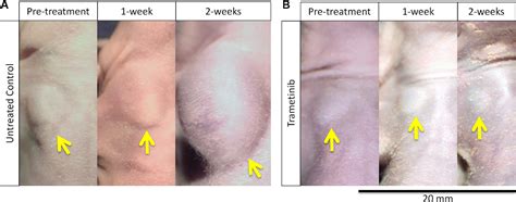 Figure From Vemurafenib Resistant Braf V E Mutated Melanoma Is