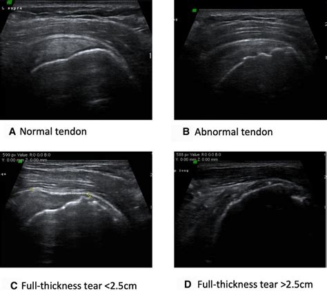 Tendon classification on ultrasound. (A) Normal tendon: normal ...