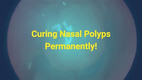 Nasal Polyps Treatment Miracle System Permanently Cure Nasal Polyps