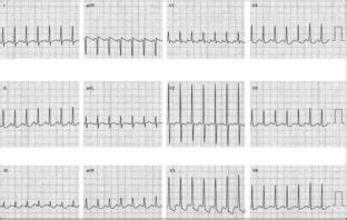 Atrial Tachycardia: Diagnosis - The Cardiology Advisor