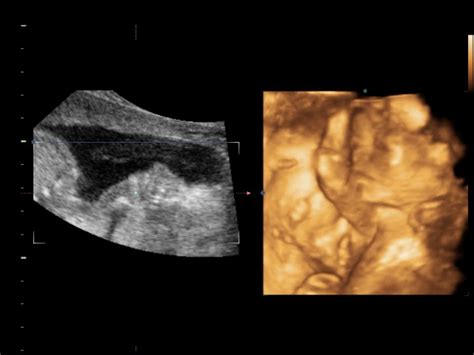 Organising: My Crazy Life: 3D Ultrasound - 20 weeks