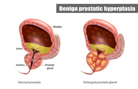 Enlarged Prostate