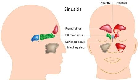 Sinus Infection Treatment Poway, San Diego - Sinusitis | Rancho ENT