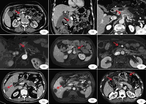 Ct Mri Tnm