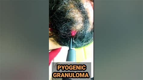 How To Remove Pyogenic Granuloma Pyogenic Granuloma Treatment