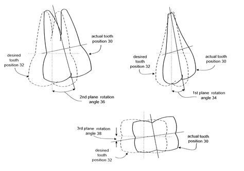 Mechanism Of Tooth Movement