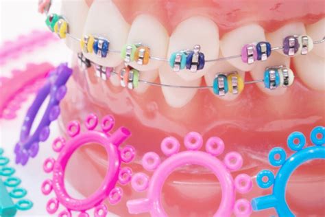 Braces Colors | Asheville, NC | Roeder Orthodontics