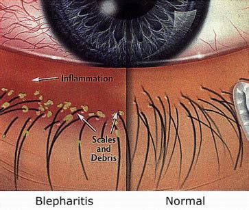 Blepharitis - Eye Infection - Symptoms - Natural Remedies ~ Medicinal Words