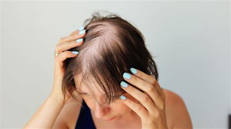 Do Vitamins For Hair Loss Actually Do Anything?