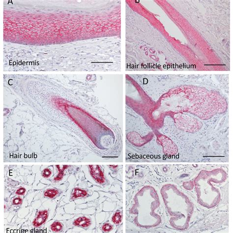 A Schematic Diagram Of Patients Empd Extramammary Pagets Disease