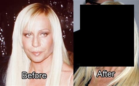 The Worst Plastic Surgery Disasters Ever (21 pics)