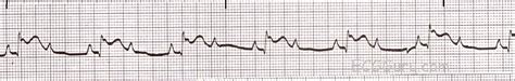 ECG Basics: 2:1 AV Block | ECG Guru - Instructor Resources