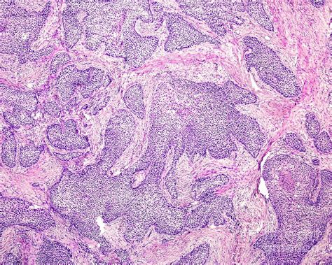 Basaloid Squamous Cell Carcinoma Photograph By Jose Calvo Science