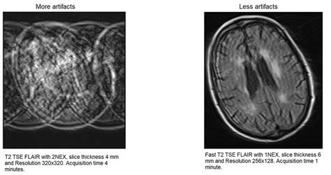 Mri Artifacts Mri Motion Artifact Ghosting Artifact Mri