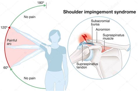 Ilustraci N Que Muestra S Ndrome De Pinzamiento Del Hombro Y Arco