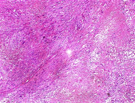 Intersecting Fascicles Of Spindle Tumor Cells With Significant Necrosis