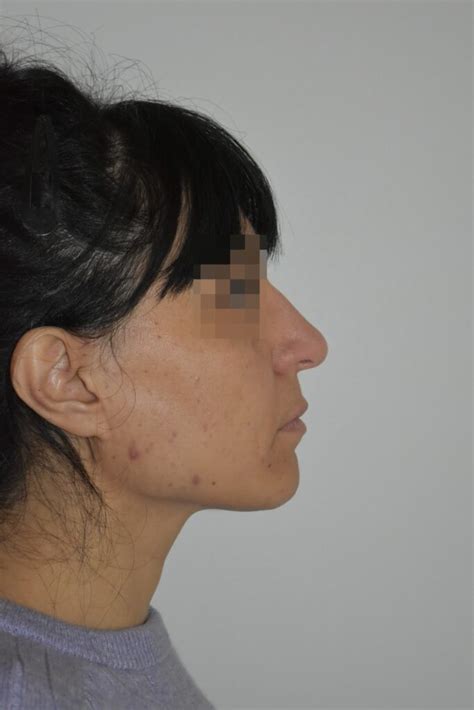 Rhinoplastie Conservatrice ultrasonique avant après