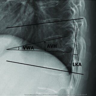 Radiologic Parameters Local Kyphotic Angle LKA Anterior Vertebral