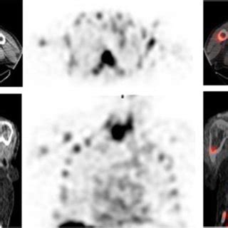 99mTc HMPAO WBC SPECT CT Images In A Patient With Suspected CIED