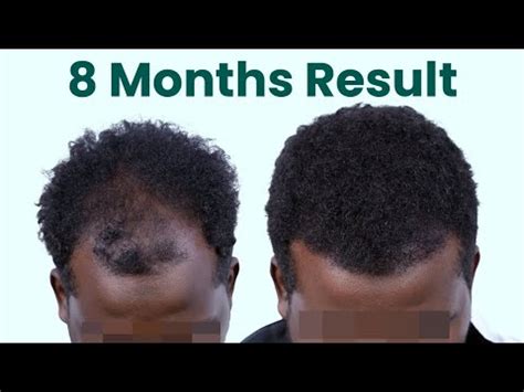 Overcoming Grade 5 Baldness With 4500 Grafts Stunning Transformation