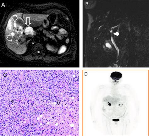 A Axial Diffusion Weighted Mri B S M Showing A Cm Expansive