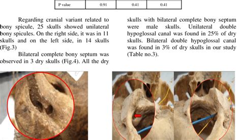 Hypoglossal Canal