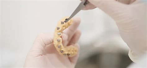 Cuanto Salen Los Brackets En Argentina Pris Oriana