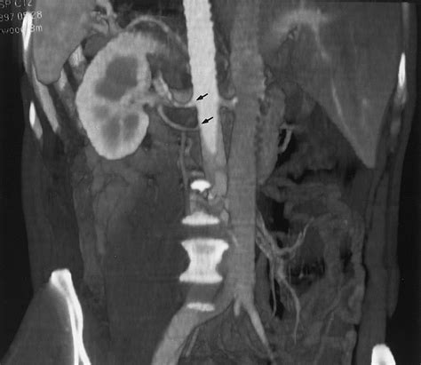 Three Dimensional Volume Rendered Ct Angiography Of The Renal Arteries